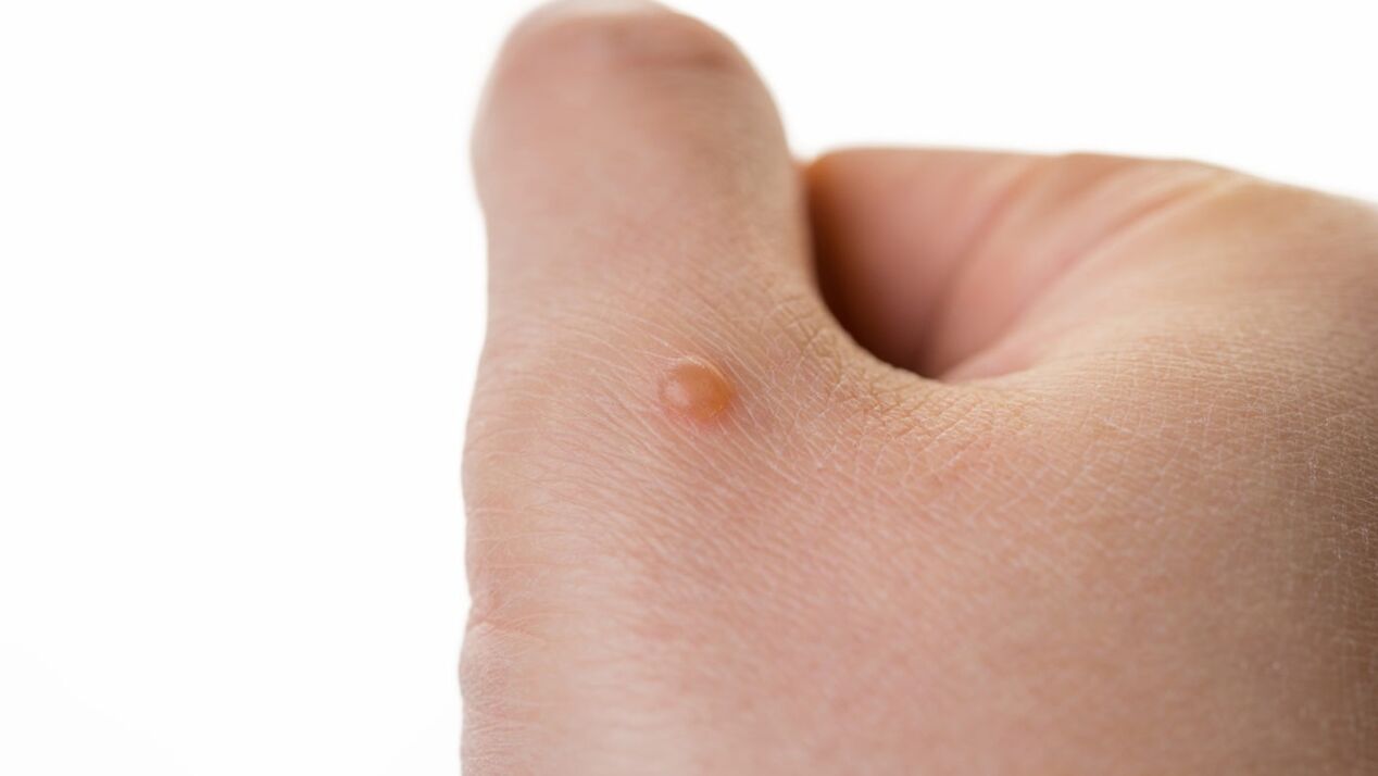 Neophagus am Arm