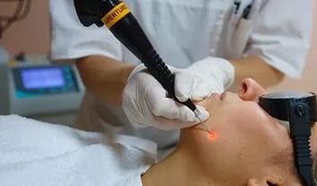 Ein wirksames Verfahren zur Entfernung von Papillomen im Gesicht mit einem Laser