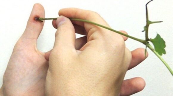 Kauterisation des Papilloms am Finger mit Schöllkrautsaft