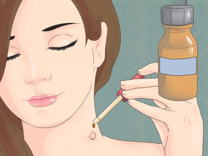 Verwenden Sie das Medikament in Form einer Lösung, um das Papillom am Hals zu entfernen