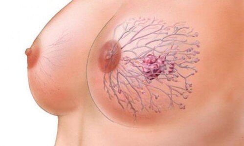 Brustpapilloma