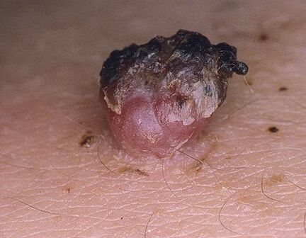 Gürtelpapilloma