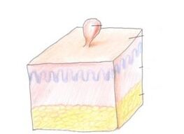 wie man Papillome am Körper loswird