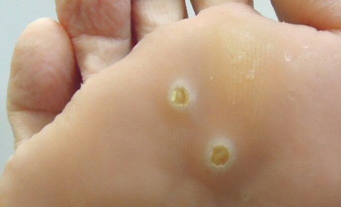 Plantarpapillome des Fußes